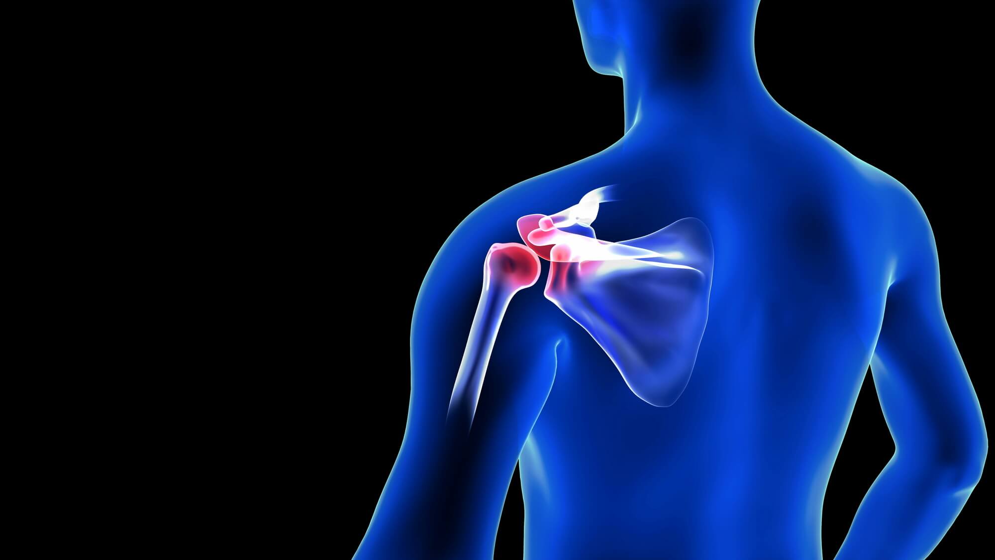 石灰沈着性腱板炎の治し方とは？急な肩の痛みの原因や症状について