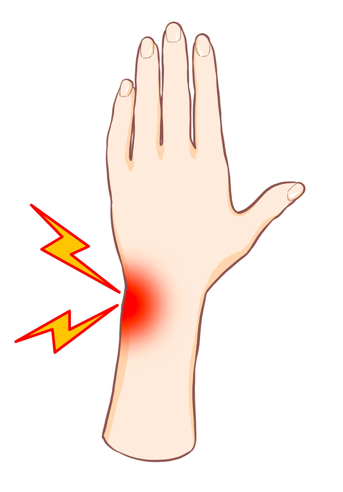 手首の小指側に痛みが出る腱鞘炎以外の疾患