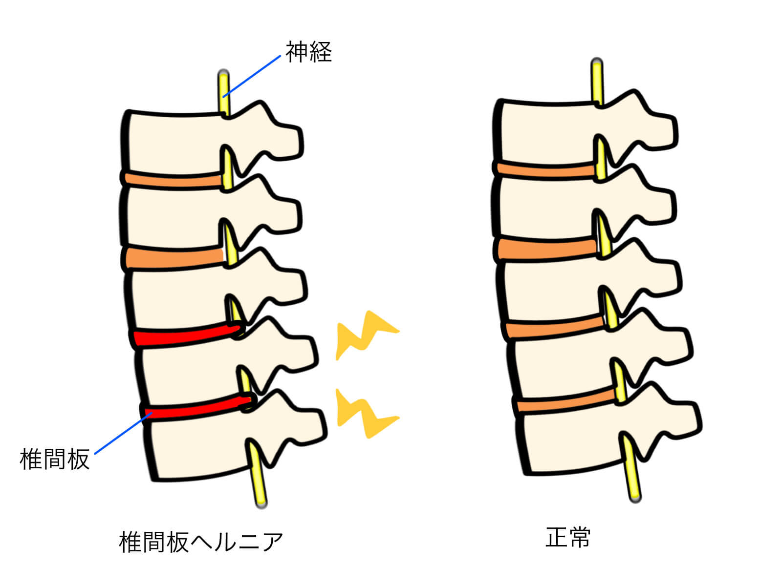 腰部疾患