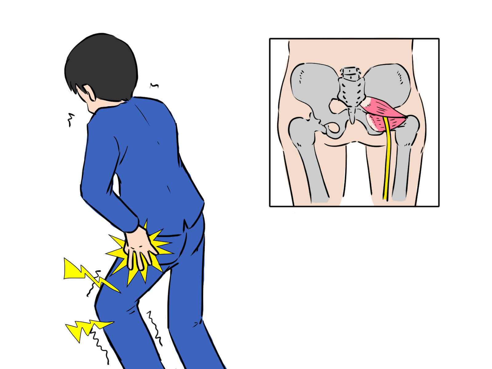 坐骨神経痛とは
