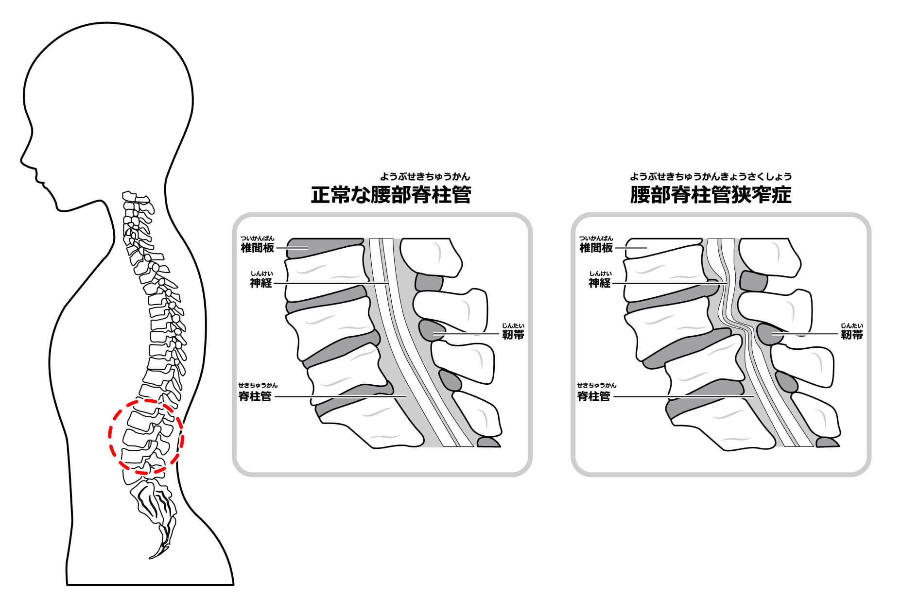 脊柱管狭窄症とは